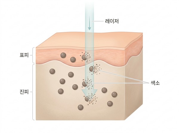 기미는 색소 깊이에 따라 유형이 나뉘고, 거울로는 알 수 없어 진료실 피부 검사로 유형을 확인해야 관리 지침이 정해진다 - 진주기미치료 | 미미썸의원 진주점