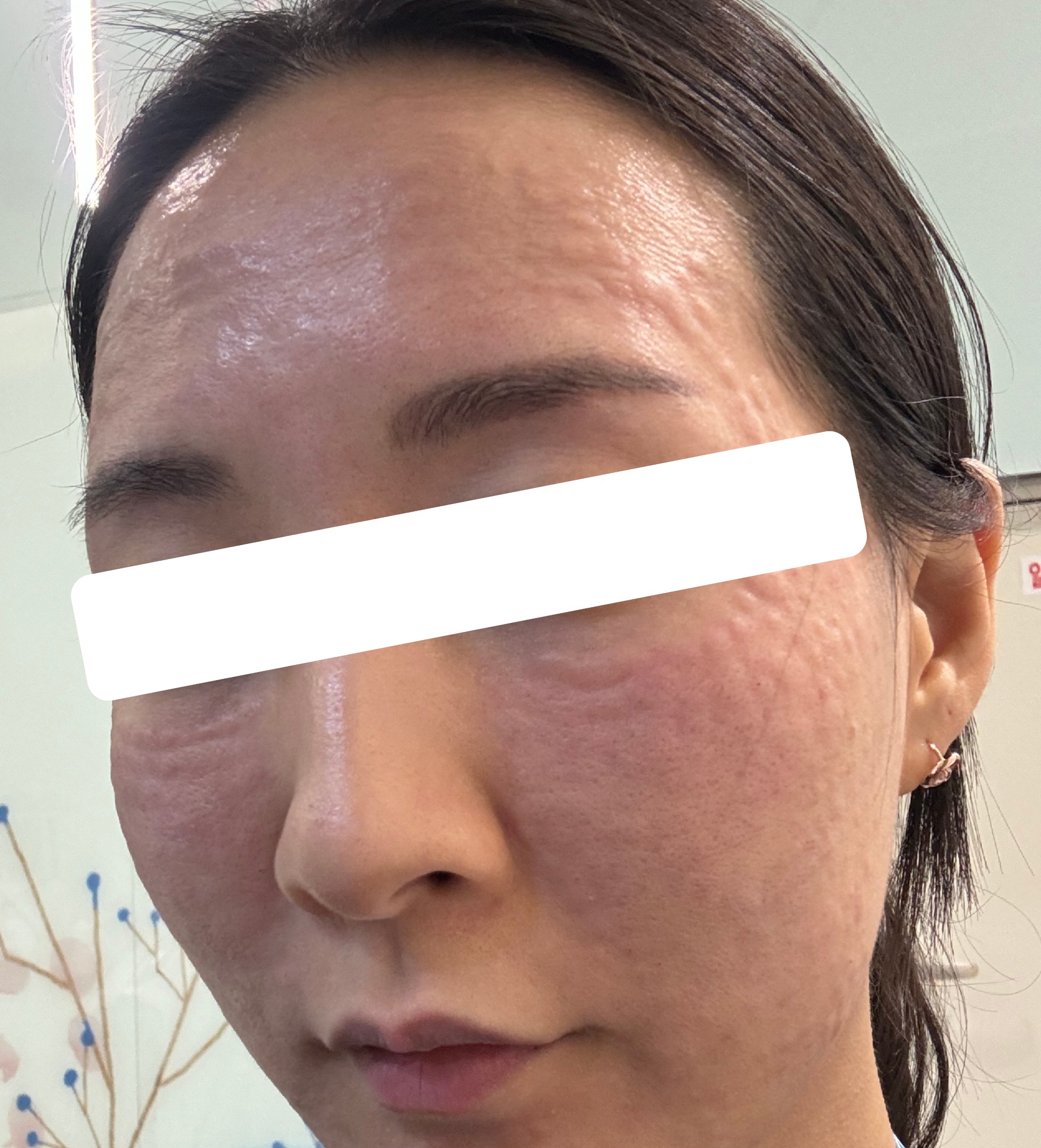 리쥬란 6cc 풀페이스로 시술받았어요.
