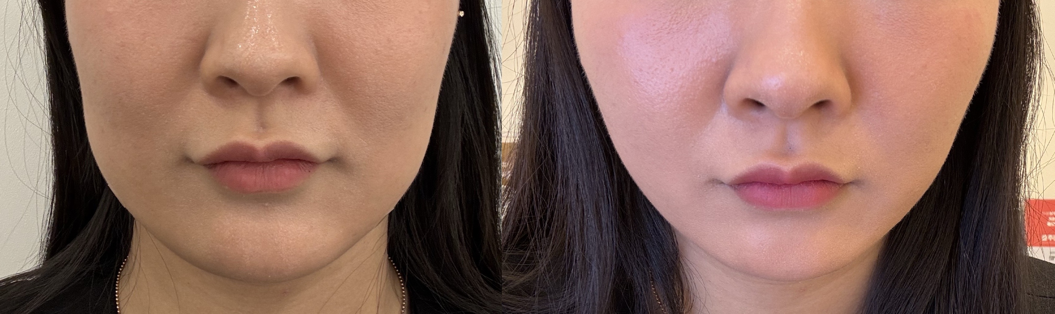 사각턱보톡스랑 양악주사!!